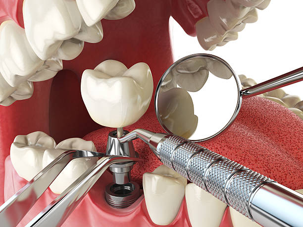 Best Knocked-Out Tooth (Avulsed Tooth) Treatment in Floresville, TX